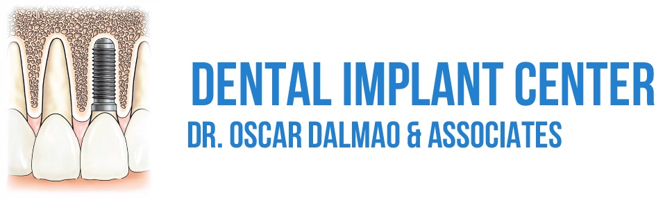 Dental Implants - Dr. Osca